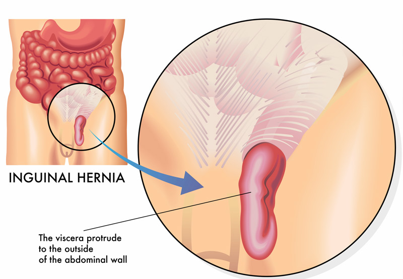 illustration-of-inguinal-hernia-Dr.-Antoine-Khoury