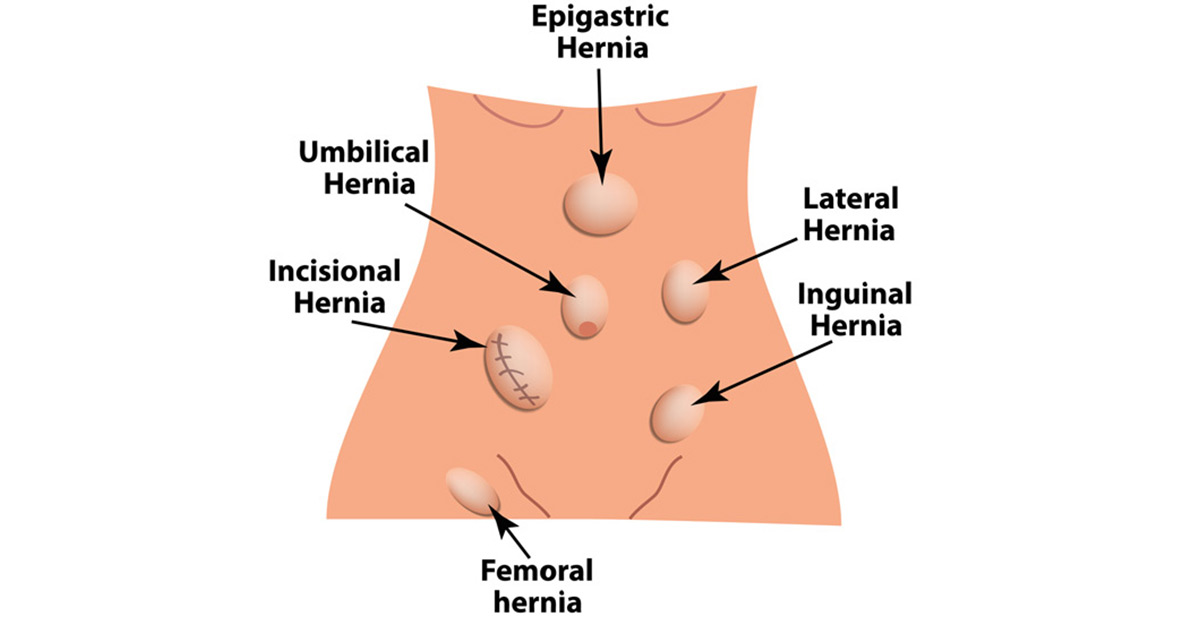 location-of-inguinal-hernia-Dr.-Antoine-Khoury