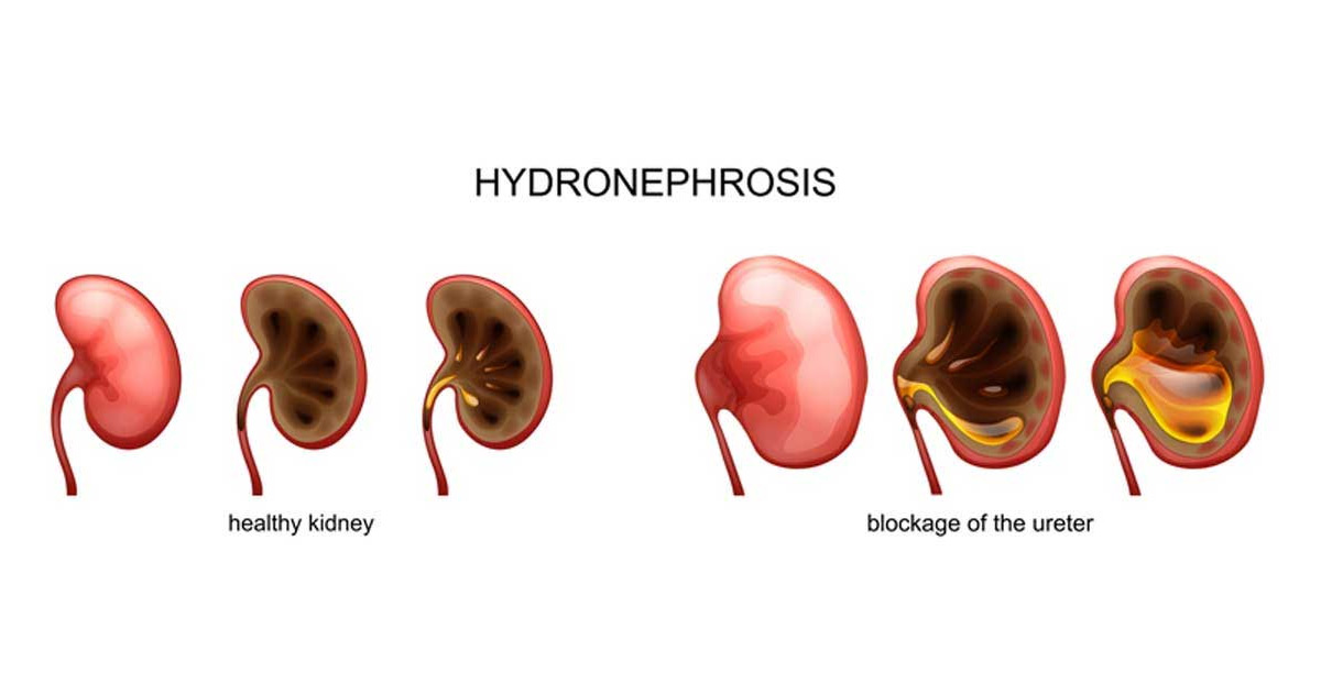 medical-concept-of-hydronephrosis-Dr.-Antoine-Khoury