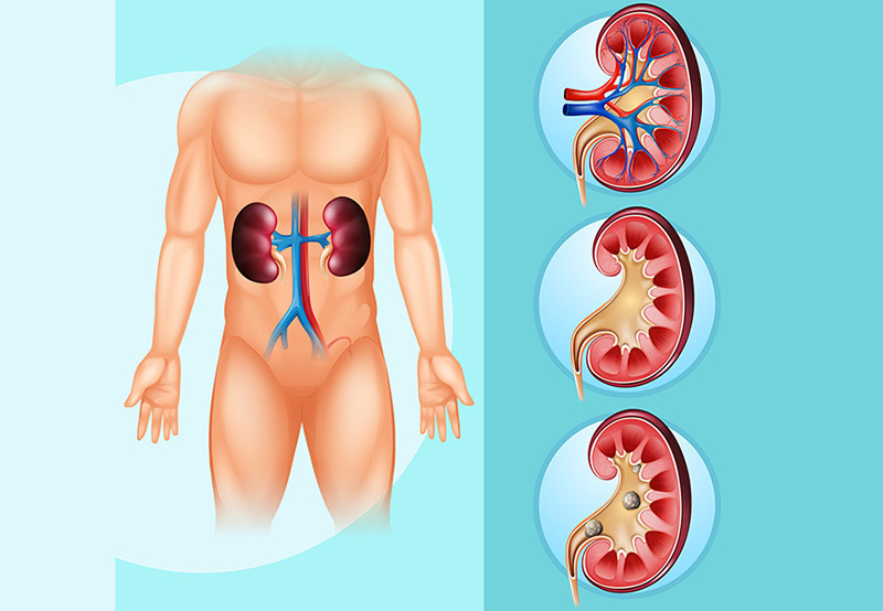 medical-concept-of-kidney-stones-Dr.-Antoine-Khoury
