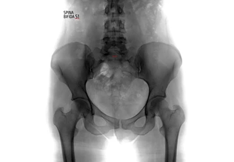spina-bifida-requiring-urologic-care-Dr.-Antoine-Khoury