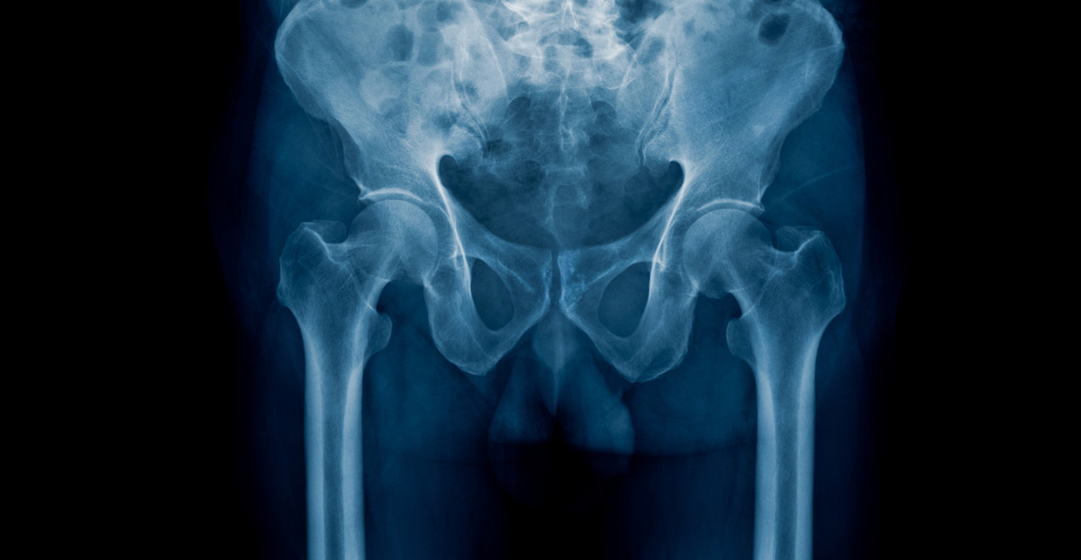 x-ray-of-pelvic-pain-related-to-genitourinary-trauma-Dr.-Antoine-Khoury
