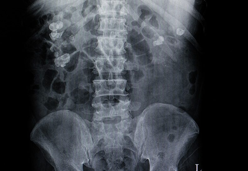 x-ray-showing-kidney-stones-a-symptom-of-ureteropelvic-junction-obstruction-Dr.-Antoine-Khoury