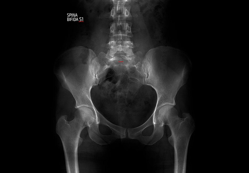 x-ray-showing-spina-bifida-Dr.-Antoine-Khoury